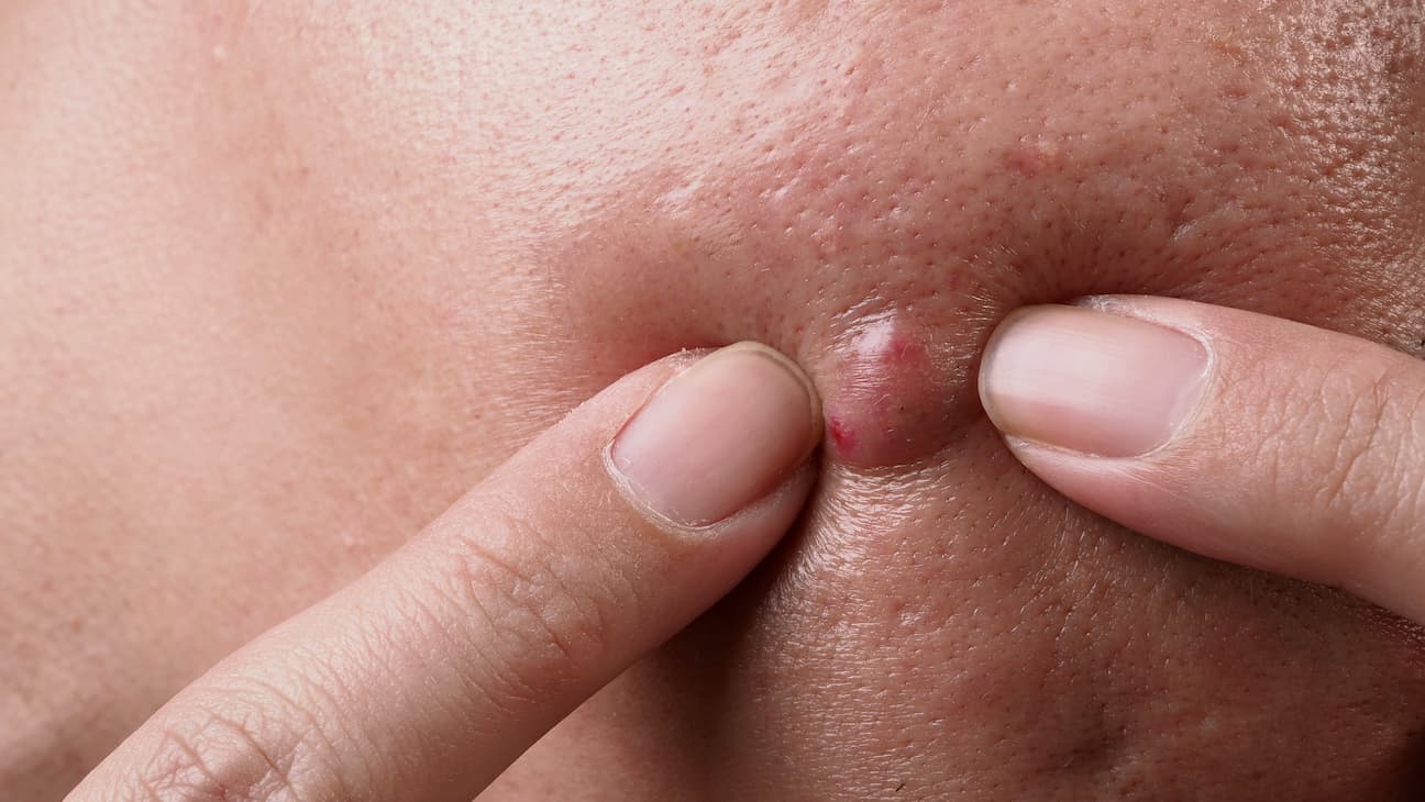 Crème après épilation pour éviter les boutons : pour une peau nickel